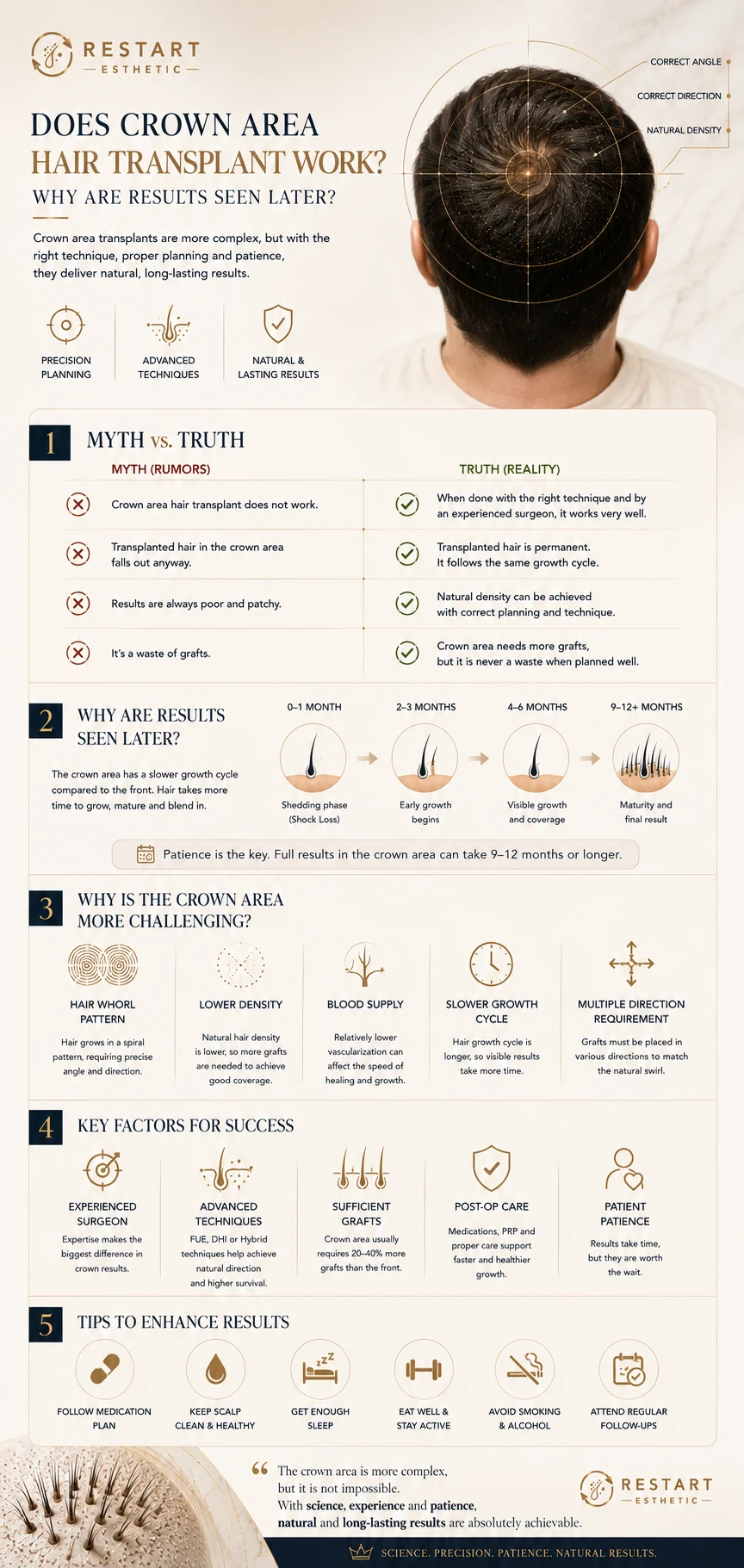 English infographic explaining crown transplant myths, the result timeline, whorl structure and key success factors